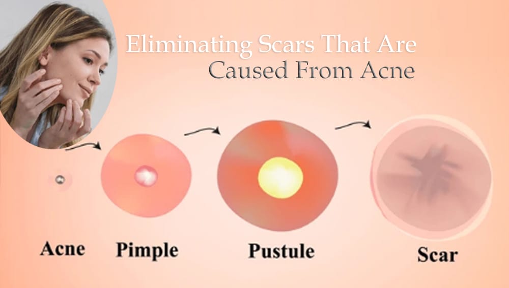 Caused From Acne
